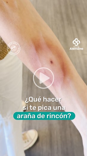 🕷¿Cómo saber si te picó una araña de rincón y qué debes hacer? En este video te lo contamos todo. ⚠Conoce las precauciones que puedes tomar para evitar las mordeduras de estas arañas: ➡Mantener limpios y ordenados rincones (atrás y debajo de muebles/ cuadros). ➡Separar las camas de los muros. ➡No colgar ropa o toallas en las paredes. ➡Revisar y sacudir la ropa y zapatos antes de ponérselos. ➡Evitar que los niños jueguen dentro de los closets o con cajas que no hayan sido revisadas. ➡Al ingresar