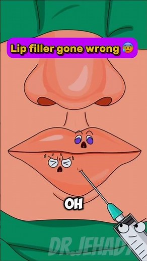 Lip Injection Fail! 💉 Hilarious Short Animation You Need to See