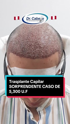 ASÍ ES UNA IMPLANTACIÓN PERFECTA DE 5,300 UNIDADES FOLICULARES. LO MEJOR para RECUPERAR el cabello perdido (alopecia, calvicie) por causa HEREDITARIA es el TRASPLANTE CAPILAR. Reserva tu cita HOY 📲 999444231 #trasplantecapilar #trasplantedecabello #implantecapilar #alopecia #calvicie #calviciemasculina #dutasteride #minoxidil #finasteride #salud #belleza #viral #tendencia