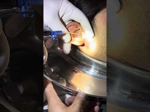 Safe Management of Traumatised Ear After Failed Foreign Body Removal Attempt.
