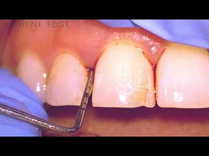 Arestin Before and After