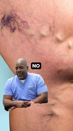 Bulging veins? Leg pain? Don’t ignore the signs. Millions of men experience vein varicose veins but few seek treatment. Get fast, effective relief with minimally-invasive procedures from board certified vein doctors. ✔️ Covered by Insurance ✔️ No Downtime ✔️ Trusted by +100,000 Patients | Metro Vein Centers | Facebook