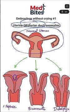 Uterine anomalies - Embryology without crying #1