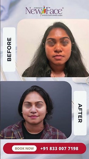 2 Weeks After Rhinoplasty | Early Healing & Nose Transformation | Dr Mathew PC