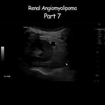 Renal Angiomyolipoma Part 7 #kidney #radiologist #radiology #radiologytutorial