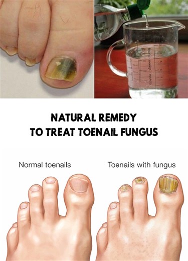how effective is vicks vaporub for toenail fungus