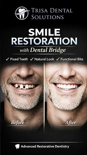 Lost Teeth to Confident Smile 😁 | Dental Bridge Smile Restoration