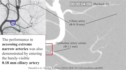 Microcatheter delivers therapies to the tiniest blood vessels