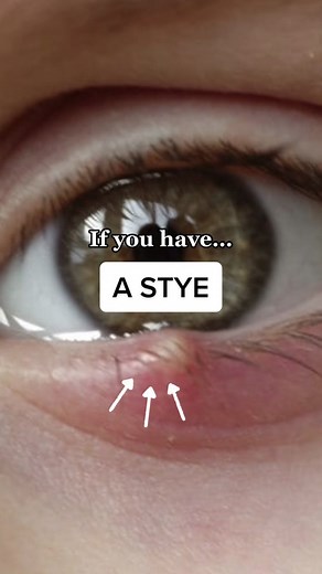 Effective Home Remedies for Eye Stye Relief and Prevention