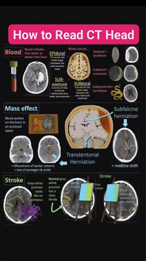 2.1K views · 14 reactions | How to Read CT Head #CTscan #ctscanner #CTscan #medicalstudent #medicalcollege #MedicalEducation #medical #radiology #holidayevent #STEM #localmarket #relationships #smokefree #babyformula #communitysupport #charityevent #localfundraiser #short #shortsfeed #shortsreels #EDH #job #reelsvideoシ | Ajammeel Khan | Facebook