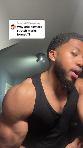 Understanding and Dealing with Tiger Stripes and Stretch Marks at the Gym