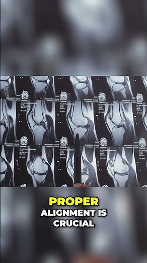 Understanding the Medial Retinaculum: Knee Health Explained