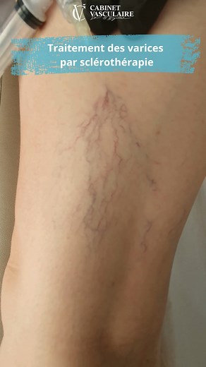 💉 Traitement par Sclérothérapie. Une solution précise et douce pour réduire les varices et retrouver des jambes légères, confortables et en pleine santé. Pour plus d'informations, visiter notre site via le lien suivant : https://varicescasablanca.ma/ Ou contactez-nous: ☎️ 0522982844 📞 0669011919 📧 drhbenjelloun@gmail.com 📍 62, croisement route d'El Jadida et Abderrahim Bouabid, Casablanca, Maroc. #docteurvaricescasablanca #Maroc #circulation_sanguine #laser #drhamzabenjelloun #docteur #الربا
