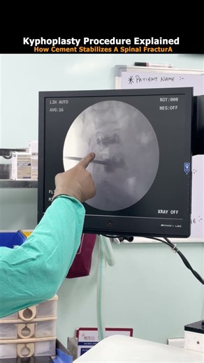 Kyphoplasty Procedure Explained How Cement Stabilizes a Spinal Fracture
