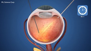 How a new eye device restores reading vision to blind eyes