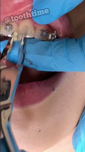 Braces Removal videos - PRO and CONS of wearing braces -Tooth Time Family Dentistry New Braunfels