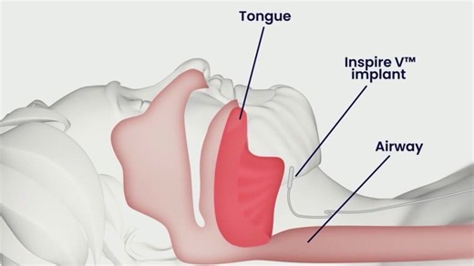 Implant could treat sleep apnea without CPAP