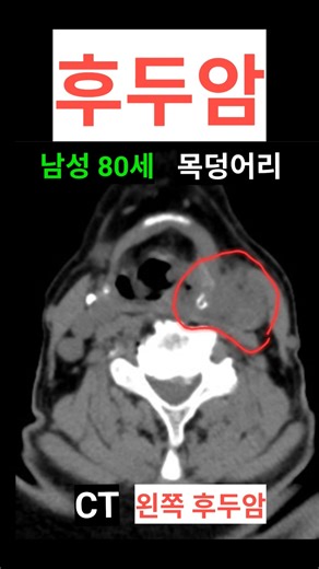 후두암 CT 진단