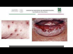 Lesiones de cavidad oral 2