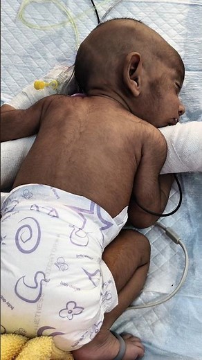 Newborn Baby in Prone Position 👶 | NICU Care | Neonatal Care #Shorts