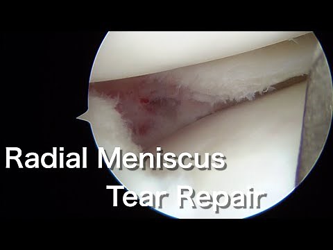 半月板横断裂に対する鏡視下半月板縫合術 Arthroscopic Meniscus Radial Tear Repair