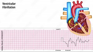 Ventricular Fibrillation - ECG and Heart Conduction - Electrocardiogram Medical Animation
