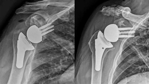 What Drives Patient Satisfaction in Shoulder Replacement?