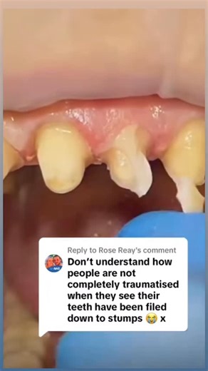 Dentite | 🦷 “Why are the teeth filed down to stumps?!” 😱 — Let’s debunk this viral myth 👇 This is a normal crown preparation, not “shaved-down... | Instagram