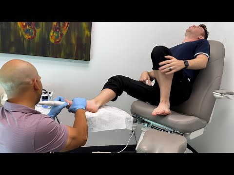 The Toe Bro Uses Painful Microwaves to Remove my Plantar Warts!