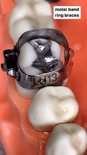 Do you use bands in your ortho treatments? | Dental Mentor