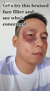 Bruised Face Filter Prank: Fun with Filter Effects!