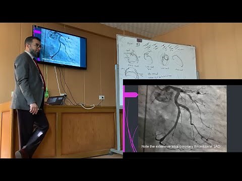 Cardiac Cath Tracing 1 (Coronary Angiography)