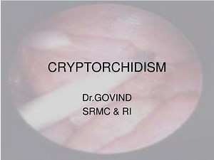 CRYPTORCHIDISM - SlideServe