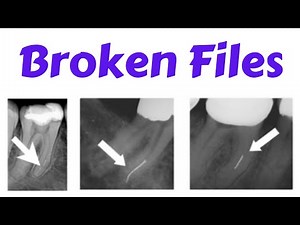 Endodontic Instrument fracture - Separated File, Management of Broken Files- Bypass Technique