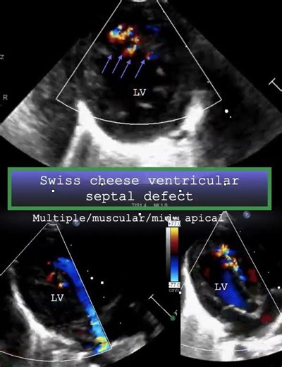 Swiss cheese ventricular septal defect