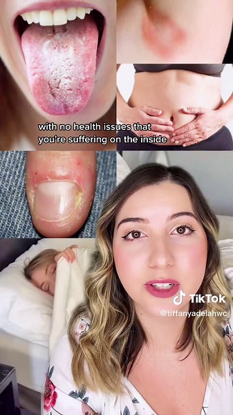 5 Physical Signs of Candida - Gut Health Tips for Women