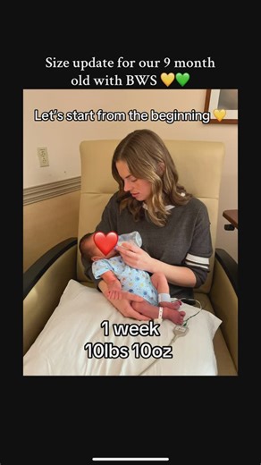 Molly ~ Christian wife, mother, homemaker on Instagram: "He was born 3 weeks early also and weighed 10lbs 10oz. Large size alone doesn’t mean BWS! Other symptoms have to be present. Beckwith-Wiedemann Syndrome is a genetic overgrowth disorder. Samuel is in a constant growth spurt until he turns 8 years old. Not all BWS children are big! Most are, but it’s a spectrum disorder so it presents itself differently in each case, some severe, others mild. Please check out my BWS playlist to learn more! 