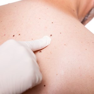 Skin Cancer Screening Near Me Ohio | Strongsville | Trillium Creek