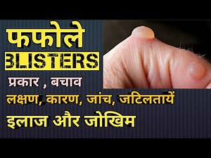 Blister (a fluid-filled skin bump) || Blisters explained in Hindi || Medhealth support