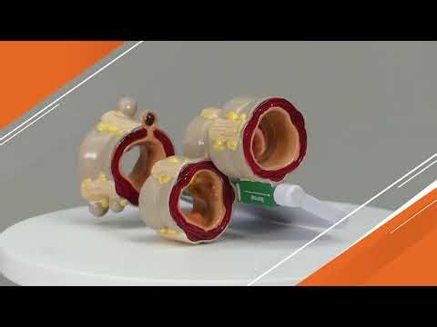 Colon Model with Pathologies (4 piece) | AnatomyStuff