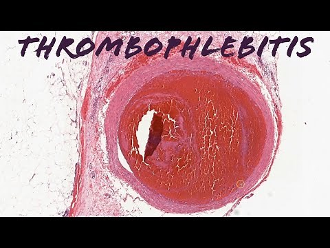 Superficial thrombophlebitis (pathology dermpath dermatology dermatopathology usmle)