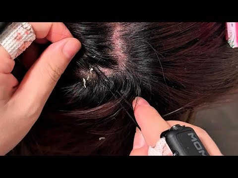 Jojo’s ASMR Scalp Therapy — Delicate Tweezer Details for Deep Calm | No Talking