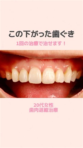 20代 女性 歯茎下がりでお悩みの方必見 #shorts #歯ぐき下がり #歯肉退縮 #知覚過敏 # CTG #歯茎 #結合組織移植
