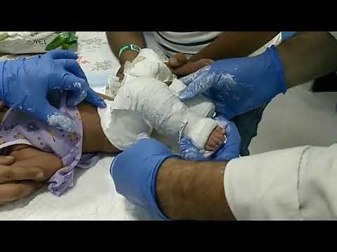 CLUBFOOT correction by PONSETI casting TECHNIQUE