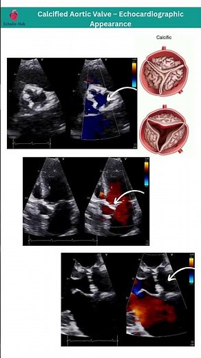 Calcified Aortic Valve – Echocardiographic Appearance