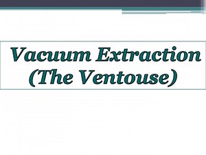 Vacuum Extraction (The Ventouse) - SlideServe