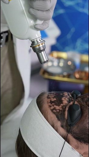 Nd:YAG Laser Technology for Medspa Treatments