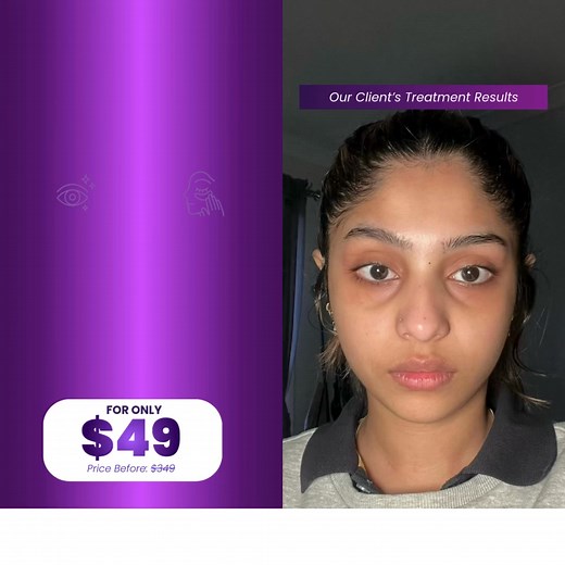 👋 San Francisco Ladies! Tired of dealing with under-eye bags, puffiness, or dark circles? Say goodbye to tired, dull-looking eyes with our advanced Bye Bye Eye Bags Treatment! Our specialized treatment is designed to rejuvenate and brighten your under-eye area, addressing: 🌼 Stubborn Under-Eye Bags 🌼 Persistent Puffiness 🌼 Dark Circles 🌼 Fine Lines & Wrinkles 🌼 Sagging or Loose Skin 🌼 Tired, Aged Appearance 🕒 Visible Results: Experience smoother, firmer, and more refreshed eyes after jus