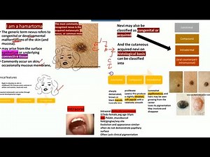 Oral nevi / Nevus HISTOPATHOLOGY,(junctional,compound and intradermal),Clinical features