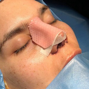 [Hot Item] Thermoplastic Nasal Splint for Rhinoplasty Nose Cast Plastic Surgery Fixation